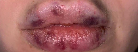 A woman's damaged lips after unlicensed filling treatment